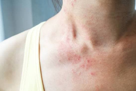 Eczema Can Affect Us All, but Some More Than Others