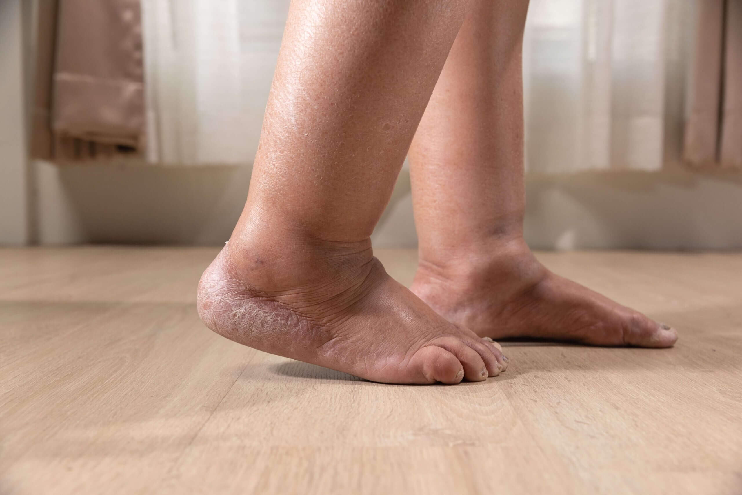 Leg Swelling in Older Adults: Causes, Prevention, and Care Tips